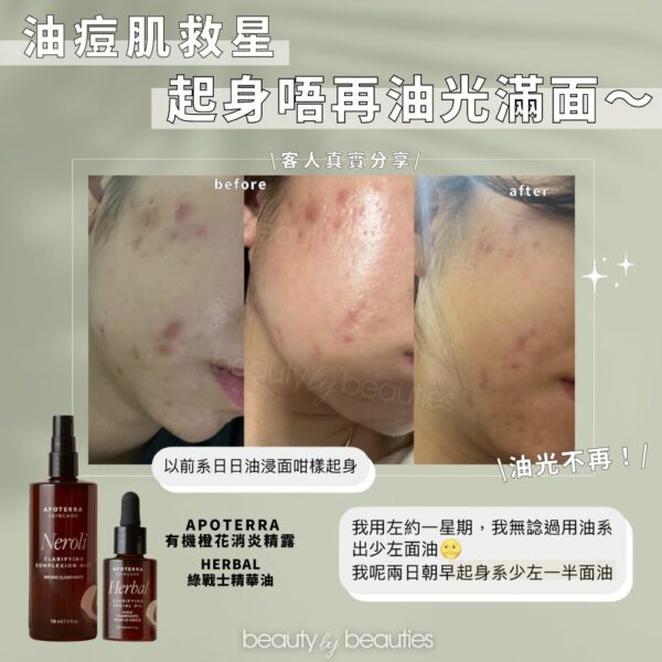 全面Kill痘戰！Apoterra Herbal 殺痘淨化．綠戰士精華油 29.6ml - Image 2
