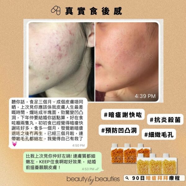 90日暗瘡拜拜療程 ! 黃金丸 + 彈彈丸 各3樽