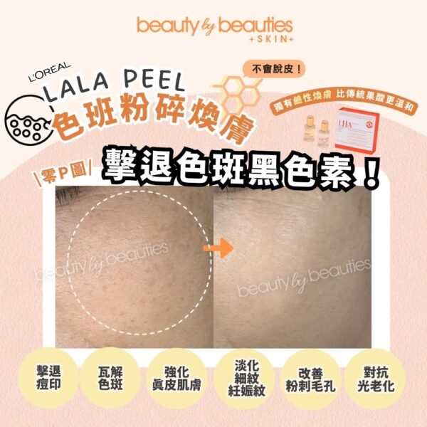 【首次體驗價】無印無斑又白滑！LALA PEEL色素痘印粉碎療程－全面 (可即時配搭高能量療程） - Image 6