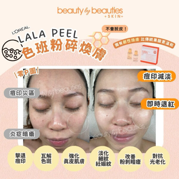 【首次體驗價】無印無斑又白滑！LALA PEEL色素痘印粉碎療程－全面 (可即時配搭高能量療程） - Image 5