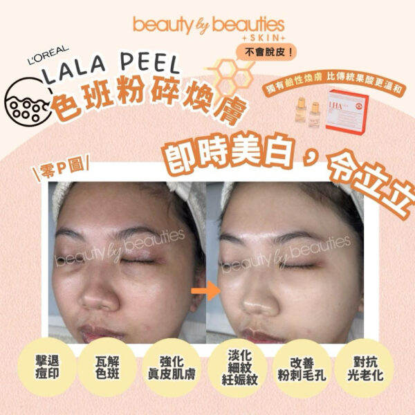 【首次體驗價】無印無斑又白滑！LALA PEEL色素痘印粉碎療程－全面 (可即時配搭高能量療程） - Image 4