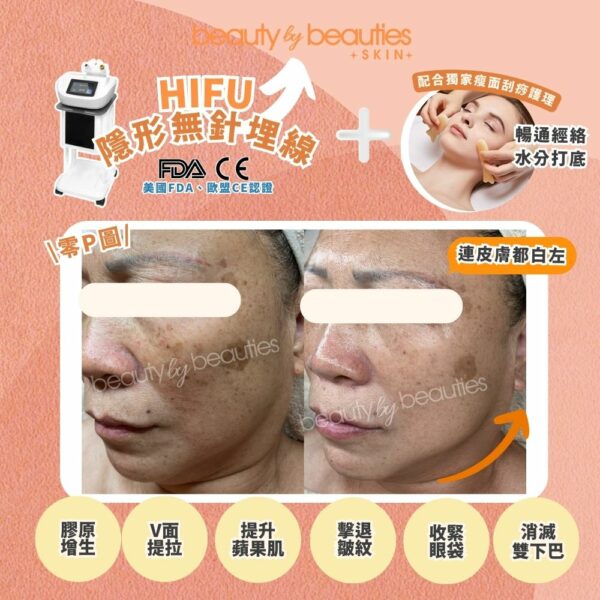 【首次體驗價】無痛V面！HIFU隱形無針埋線(全面+眼+下巴，不限發數）送《4頻細胞機修復再生療程》（價值＄1880） - Image 8