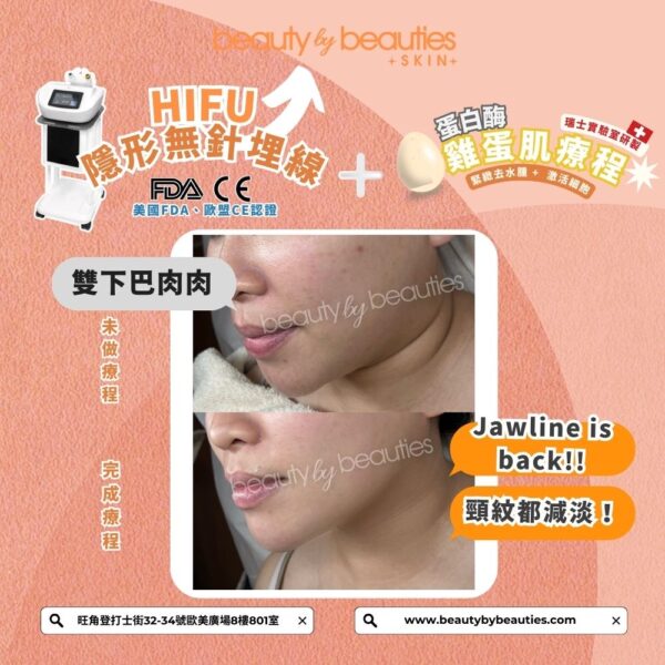 【首次體驗價】無痛V面！HIFU隱形無針埋線(全面+眼+下巴，不限發數）送《4頻細胞機修復再生療程》（價值＄1880） - Image 7