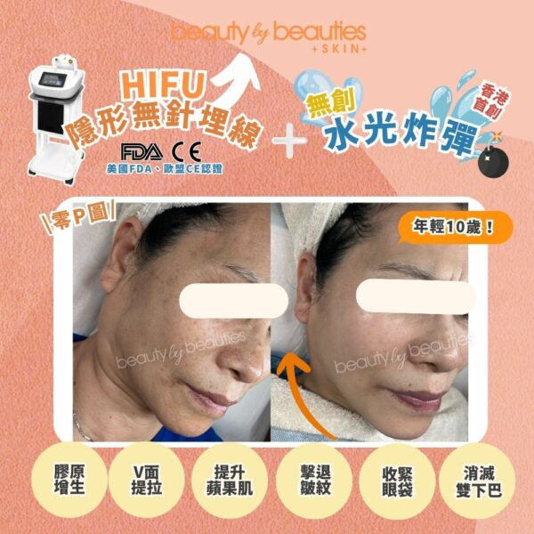 【首次體驗價】無痛V面！HIFU隱形無針埋線(全面+眼+下巴，不限發數）送《4頻細胞機修復再生療程》（價值＄1880） - Image 3