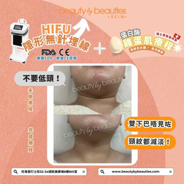 【首次體驗價】無痛V面！HIFU隱形無針埋線(全面+眼+下巴，不限發數）送《4頻細胞機修復再生療程》（價值＄1880） - Image 2