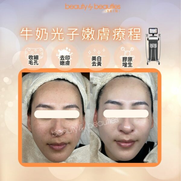 【首次體驗價】美白、嫩膚、零毛孔！牛奶光子嫩膚療程(全面） - Image 5