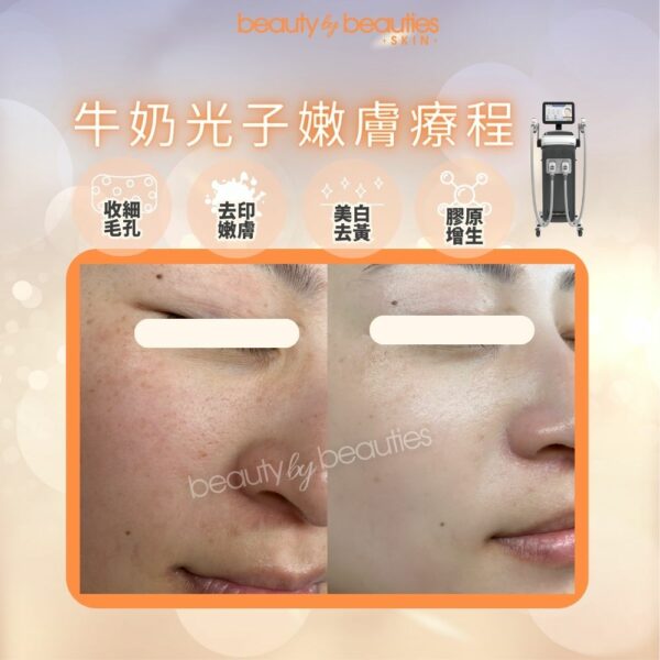 【首次體驗價】美白、嫩膚、零毛孔！牛奶光子嫩膚療程(全面） - Image 4