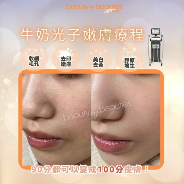 【首次體驗價】美白、嫩膚、零毛孔！牛奶光子嫩膚療程(全面） - Image 2