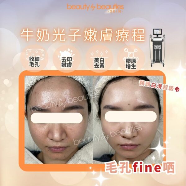 【首次體驗價】美白、嫩膚、零毛孔！牛奶光子嫩膚療程(全面） - Image 3