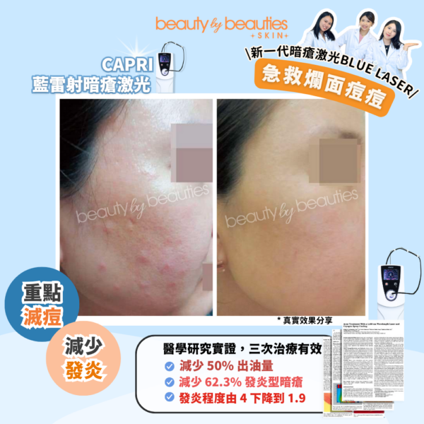 【首次體驗價】暗瘡斷尾+控油殺菌! CAPRI藍雷射暗瘡激光療程 (全面不限發數) - Image 4