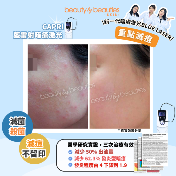 【首次體驗價】暗瘡斷尾+控油殺菌! CAPRI藍雷射暗瘡激光療程 (全面不限發數) - Image 3
